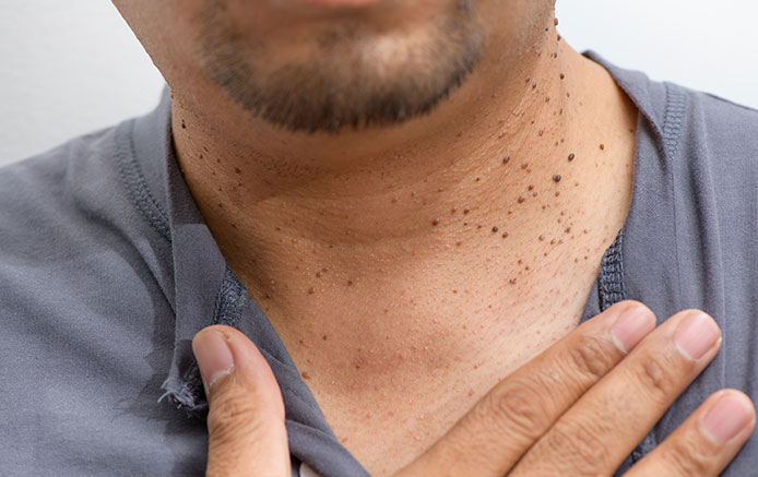 Skin Tags