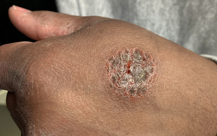 Solar Keratosis