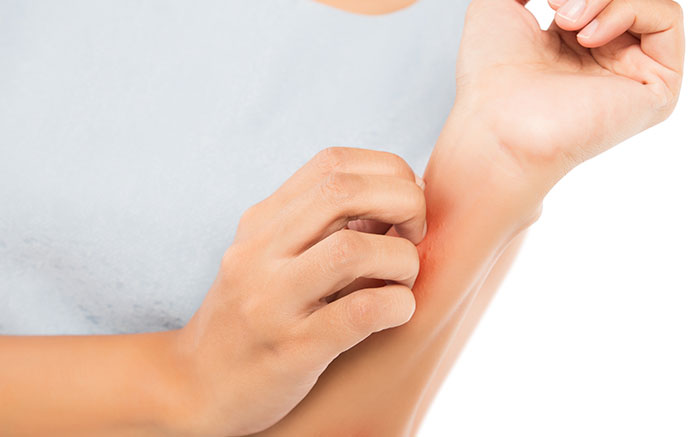Atopic Eczema