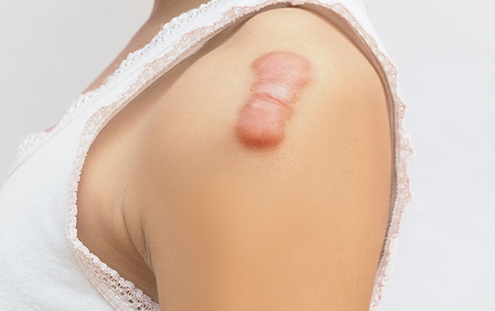 Scarring Deformities