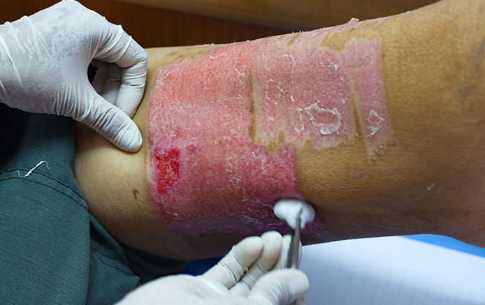 Removal of Skin Cancer and Reconstructive Grafting