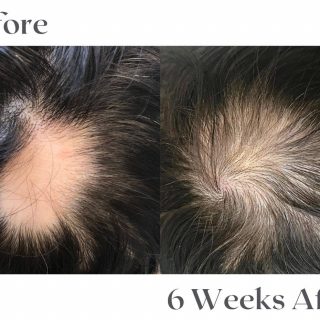 alopecia-areata-9