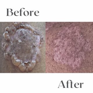 bullous-pemphigoid-2