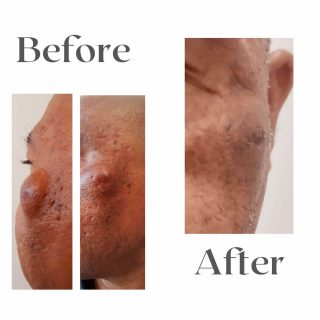 epidermoid-cyst-1