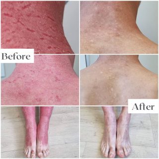 exfoliative-dermatitis-5