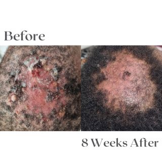 folliculitis-decalvans-6
