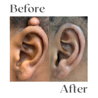 keloid-4