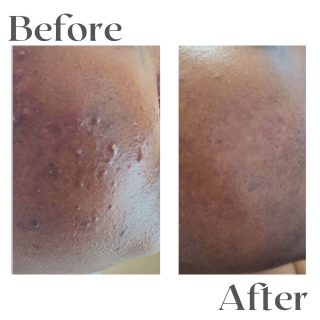 pustular-acne-3