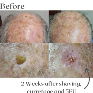 solar-keratosis-8